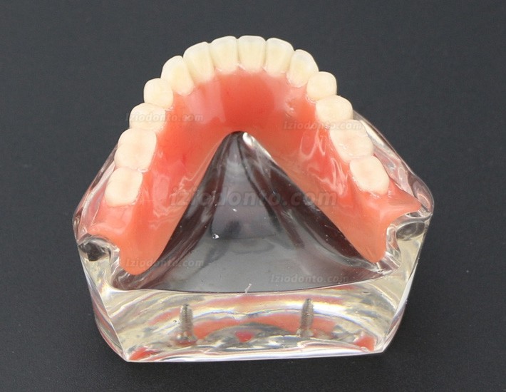 Dentes dentais modelo sobredentadura inferior com 2 implantes 6002 01